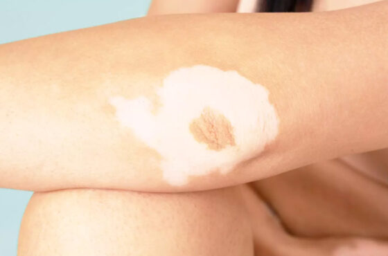Vitiligo et spray tan : camoufler sa peau ou reprendre le contrôle de son image ?